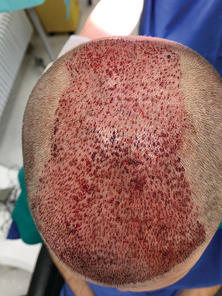 Процесс пересадки волос