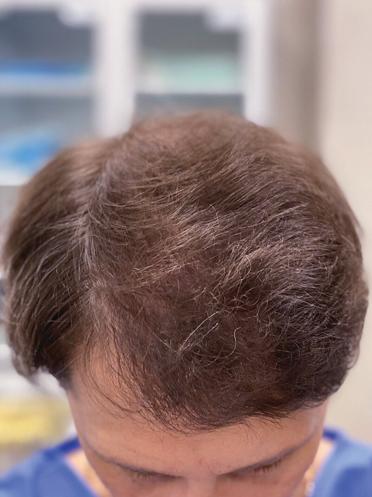 После пересадки волос