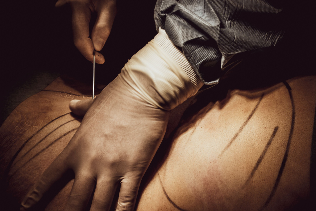 Пластическая хирургия живота Пластическая хирургия живота