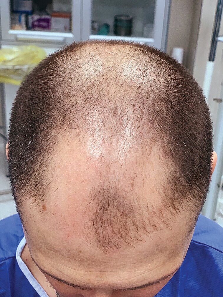 До пересадки волос