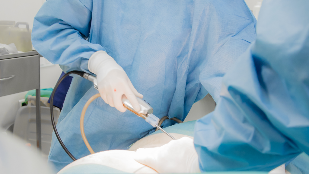 Липосакция